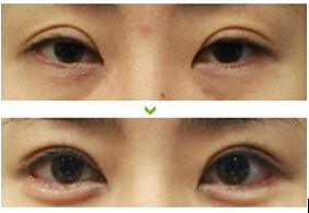 齊齊哈爾上瞼松弛矯正價(jià)格
