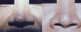 吉林酒糟鼻價(jià)格