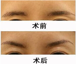 齊齊哈爾眉弓填充價格
