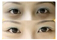 齊齊哈爾去黑眼圈價格