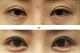 無錫上瞼松弛矯正價(jià)格