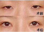 齊齊哈爾眼部綜合術(shù)價(jià)格