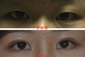 常州上瞼下垂矯正價格