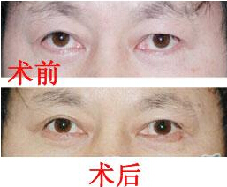 齊齊哈爾眼瞼外翻矯正價格