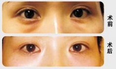 齊齊哈爾眼苔再造價格