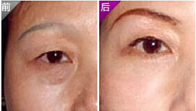 無(wú)錫切眉術(shù)價(jià)格
