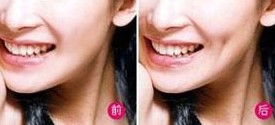 吉林人造酒窩價(jià)格