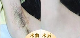 吉林脫腋毛價格