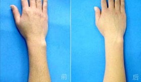 吉林手臂脫毛價格
