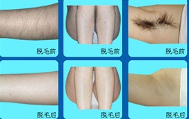 吉林全身脫毛價格
