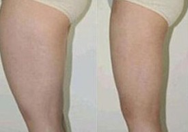 吉林大腿吸脂價(jià)格