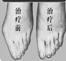 大連寬腳變窄價格