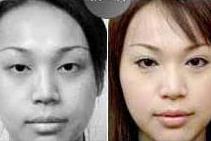 張家口雙眼皮價格