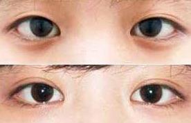 張家口雙眼皮失敗修復(fù)價格