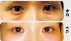 張家口眼苔再造價格