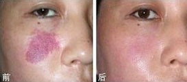 吉林鮮紅斑痣價格