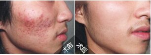 吉林復(fù)合彩光嫩膚價(jià)格