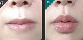 無錫薄唇增厚價(jià)格