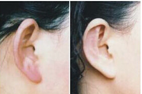 齊齊哈爾菜花耳整形價格