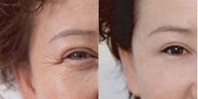 吉林BOTOX除皺價格