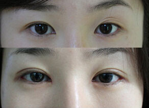 九江雙眼皮失敗修復(fù)價格