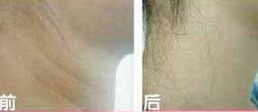吉林頸部除皺價格
