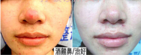 九江酒糟鼻價(jià)格