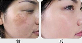 無錫激光去黃褐斑價格