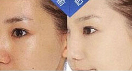 無錫收縮毛孔價格