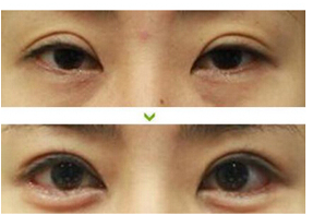 江蘇宿遷上臉?biāo)沙诔C正術(shù)價(jià)格