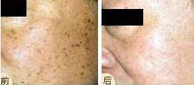 無錫激光去老年斑價格