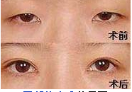 江蘇宿遷眼部綜合術價格