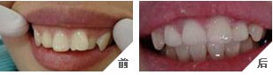 吉林牙齒矯正價(jià)格