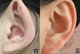 無錫杯狀耳矯正價格