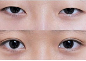 萍鄉(xiāng)韓式雙眼皮價(jià)格