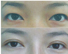 萍鄉(xiāng)水泡眼矯正價(jià)格