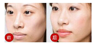 萍鄉去咬肌瘦臉價格