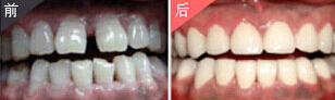 無(wú)錫烤瓷牙價(jià)格