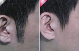 上饒發際線脫毛價格