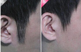 萍鄉發際線脫毛價格