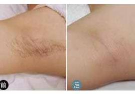 南京脫腋毛價(jià)格