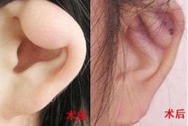 張家口耳垂畸形修復價格
