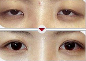 鞍山上瞼松弛矯正價格