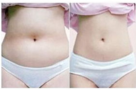 萍鄉(xiāng)腰腹部吸脂價格