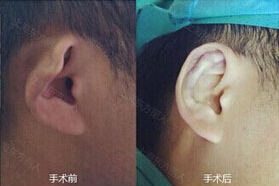 九江招風(fēng)耳矯正價(jià)格