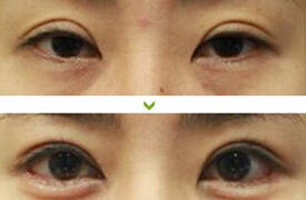 寧德上瞼松弛矯正價格