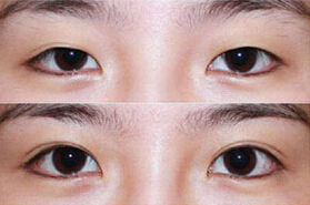 湘西雙眼皮失敗修復(fù)價(jià)格