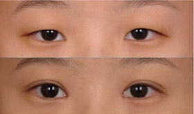 湘西上瞼下垂矯正價格