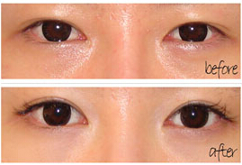 亳州眼角開大價格