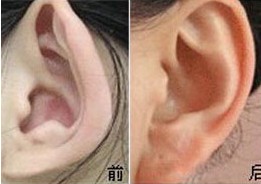 上饒杯狀耳整形價格